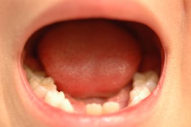 乳歯は永久歯に比べてむし歯になりやすい！