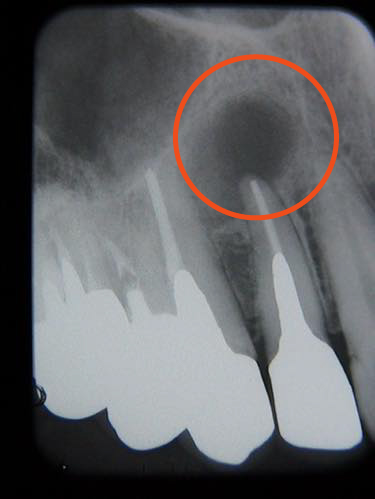 処置終了直後：歯の根先には膿の袋があります
