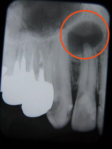 治療前：右の細い歯の先に黒く巨大な膿の袋