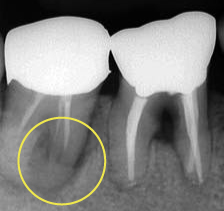 治療前：右下・奥歯・手前の大きな歯