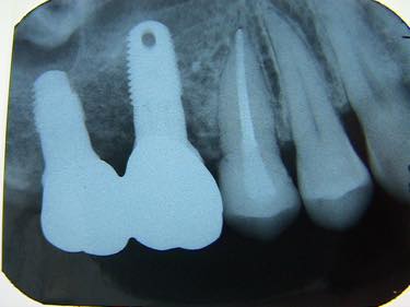 治療後：奥2箇所にインプラント、手前の歯は「ピッタリ根充」＝精度の高い治療であなたの歯を護ります。被せたセラミック冠はアメリカの学会で発表した方法で作成）