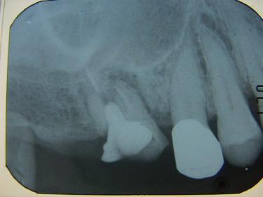 治療前：右上の奥歯↑の崩壊と手前の↑歯はむし歯